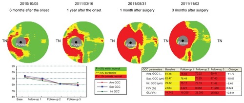 Figure 4 Optical coherence tomography.