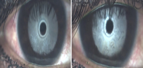 Figure 6 Interferometry patterns example in the sirolimus-loaded liposomes group. Pre-treatment (left) and post-treatment (right).