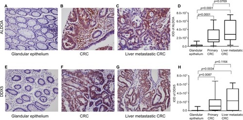 Figure 1 Expression of ALDOA and DDX5 in paired adjacent glandular epithelium, primary colorectal cancer, and liver metastatic colorectal cancer tissue.Notes: Expression of ALDOA in (A) adjacent glandular epithelium (×200), (B) primary colorectal cancer tissue (×200), (C) liver metastatic colorectal cancer tissue (×200). (D) Box plot showing the staining intensity (mean with SEM) of ALDOA in paired adjacent glandular epithelium, primary colorectal cancer, and liver metastatic colorectal cancer tissues. Expression of DDX5 in (E) adjacent glandular epithelium (×200), (F) primary colorectal cancer tissue (×200), (G) liver metastatic colorectal cancer tissue (×200). (H) Box plot showing the staining intensity (mean with SEM) of ALDOA in paired adjacent glandular epithelium, primary colorectal cancer, and liver metastatic colorectal cancer tissues.Abbreviations: ALDOA, fructose-bisphosphate aldolase A; CRC, colorectal cancer; DDX5, DEAD box p68 RNA helicase; IOD, integrated optical density.