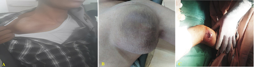 Figure 1 Arterial aneurysms caused by repeated central line access (A) Right subclavian artery aneurysm. (B) left subclavian to axillary artery aneurysm. (C) left brachial artery pseudoaneurysm).