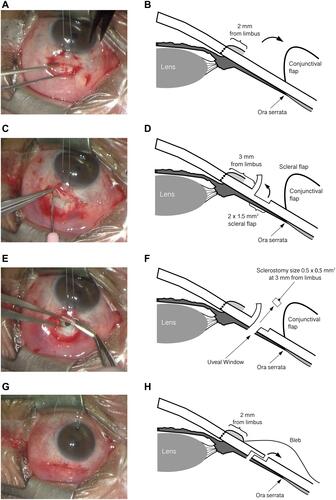 Figure 1 Photographs (A, C, E and G) and diagram (B, D, F and H) showing pars planectomy technique. (A, B) A fornix-based conjunctival incision was created at 2 mm from the limbus with a length of 5–6 mm. (C, D) A half-thickness scleral flap with a size of 2×1.5 mm2 was created at 4.5 mm from the limbus. (E, F) A pars plana window with a size of 0.5×0.5 mm2 was created precisely at 3 mm from the limbus, and exposed uveal tissue was cauterized to create a uveal window. (G, H) The scleral and conjunctival flap were closed with Nylon 10–0 monofilament sutures. (B, D, F and H) were illustrated by the authors. Permissions were already obtained.