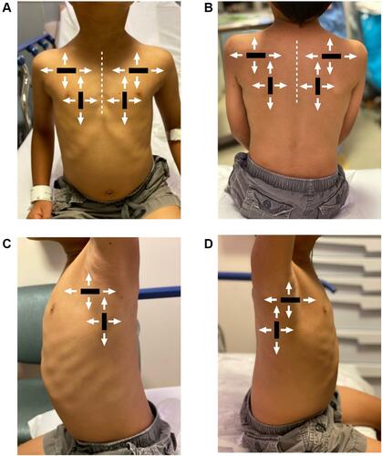 Figure 1 The recommended 6-zone pediatric lung ultrasound scanning protocol. The thorax is divided into 3 regions including anterior (A), posterior (B) and lateral (C and D) lung fields. Each region is scanned with the transducer in both the longitudinal and transverse orientations, scanning both cranial-caudal, and medial-lateral at each region.