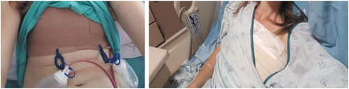 Figure 1. Performative aspect post-removal surgery (pictures sent by the interviewees, published with their permission).