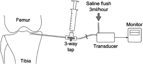 Figure 1. Study instrumentation. This schematic diagram shows the proximally directed 22-gauge spinal needle placed through the medial cortex of the tibia, connected via a 3-way tap to a saline-filled syringe for flushing and a pressure transducer. The pressure transducer, line, and needle were subject to a constant low rate (3 mL/h) flushing with saline to ensure patency.