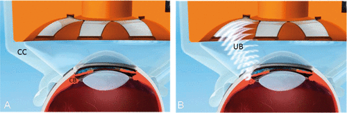Figure 3. Positioning of the device including circular piezoelectric transducers, inserted into a spacing cone in contact with the eye (A). Sequential activation of the transducers, producing an ultrasonic beam which selectively destroys a well-defined portion of the ciliary body (B). CC: coupling cone. CB: ciliary body. UB: ultrasound beam.