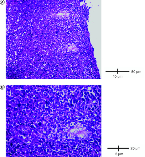 Figure 3. Histological examination.(A) A diffuse infiltrate of the colon mucosa that didn't invade crypts (HE × 200). (B) The infiltrate was composed of medium to large cells with atypical nuclei and numerous mitoses (HE × 400).