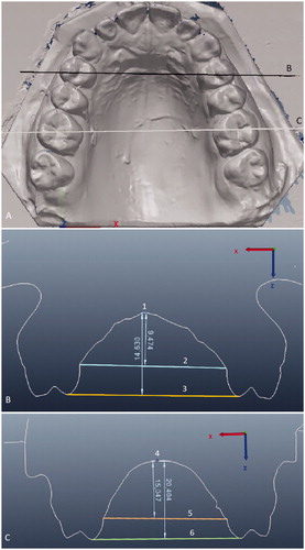 Figure 2. Palatal height measurements. (A) The black line marked B indicates the cross-section level in (B), and the white line marked C indicates the cross-section level in (C). B) Anterior palatal height measured from the mid-palate (1) to two reference lines: a line (2) drawn at the gingival margin level of the first premolars, and a line (3) on their palatal cusp tips. C) Posterior palatal height measured from the mid-palate (4) to two reference lines: a line (5) drawn at the gingival margin level of the first permanent molars, and a line (6) on their mesiopalatal cusp tips.