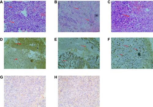 Figure 2 The pathological examination of postoperative. (A) Some lamellar tumor cells, different sized cells, atypia, coarse chromatin, obvious nuclear division, and osteoclast-like cells. (B) Some tumor cells were tubular, while some were fusiform and atypical, with different sizes and in different stages of nuclear division. (C) Some cells are necrosis in the center of the tumor. (D) VIM (+) (4X10). (E) CD56 (+) (4X10). (F) ki-67 40% (4X10). (G) ER (-) (10X10). (H) PR (-) (10X10).