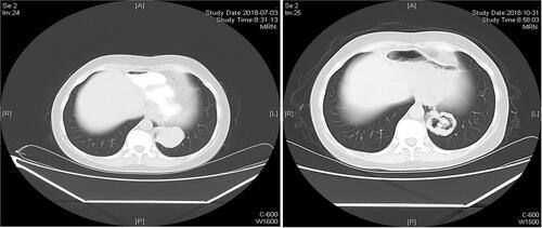 Figure 3 The MRI scan changes of target lesions in colorectal cancer patients with lung metastases after 4 cycles of apatinib treatment.