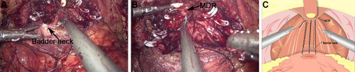 Figure 2 The second layer of the reconstruction of the posterior wall of total urethral reconstruction of “Sandwich”. (A) The structural location of the MDR during the operation. (B) The structural location of the posterior lip of the ladder neck. (C) MDR was sutured with the bladder wall at the back of the posterior lip of the bladder neck.