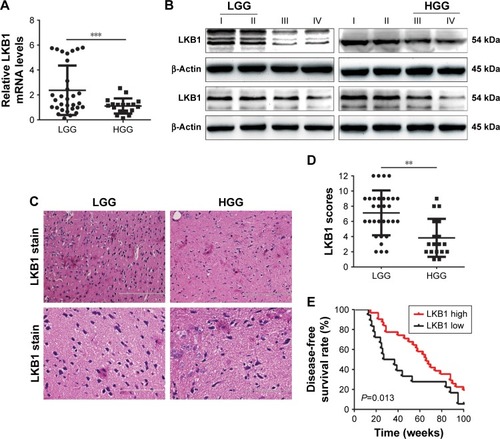 Figure 1 LKB1 is often downregulated in human gliomas.Notes: (A) Relative LKB1 expression levels measured by RT-PCR in 31 patients with LGG and 18 patients with HGG. (B) Sixteen glioma tissues were assessed for LKB1 expression by Western blot, including four grade I, four grade II, four grade III, and four grade IV. (C) Representative images and (D) scores of the IHC analysis of LKB1 expression in the paraffin-embedded different grade glioma. (E) Kaplan–Meier curves for DFS of glioma patients with low vs high expression of LKB1. The median LKB1 expression was used as the cutoff value. Statistical significance was assessed using two-tailed Student’s t-test. Scale bars: 50 µm. **P<0.01, and ***P<0.001.Abbreviations: DFS, disease-free survival; HGG, high grade glioma; IHC, Immunohistochemical; LGG, low grade glioma; LKB1, liver kinase B1; RT, real-time.