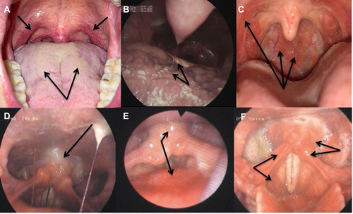 Figure 1 Findings in patients with laryngopharyngeal reflux.