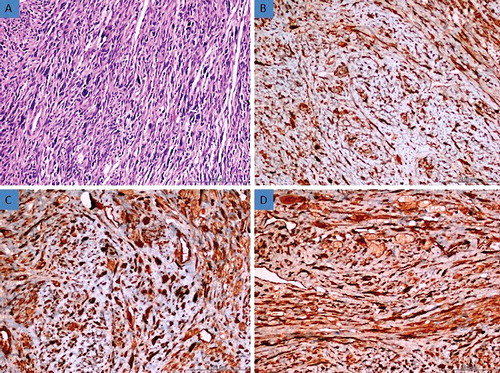 Figure 3. (a) Histomorphological appearance of the bizarre leiomyoma (H&E, 200×). (b) Strong expression of AQP3 in bizarre leiomyoma tissue (Immunoperoxidase, 200×). (c) Strong expression of AQP7 in bizarre leiomyoma tissue (Immunoperoxidase, 200×). (d) Strong expression of AQP9 in bizarre leiomyoma tissue (Immunoperoxidase, 200×).