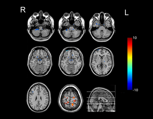 Figure 2 The cerebral regions with significantly different normalized CBF between the GTCS patients and healthy subjects in the axial sections. (FWE corrected p < 0.05). The normalized CBF was significantly decreased in the bilateral brainstem, right cerebellum, right inferior temporal gyrus, right parahippocampal gyrus, right superior frontal gyrus (orbital part), right superior frontal gyrus, frontal middle gyrus, inferior frontal gyrus (triangular part), left temporal pole and thalamus. The normalized CBF was increased in the bilateral superior parietal gyri, bilateral precuneus, bilateral precentral gyri, bilateral postcentral gyri, left superior frontal gyrus (dorsolateral part), and right superior parietal gyrus.