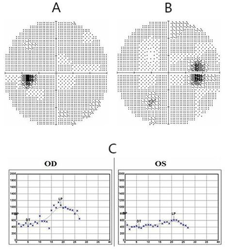 Figure 3 The visual field of left eye was normal (A) and the physiological blind spot in the right eye exhibited a slight enlargement (B). EOG revealed an Arden ratio of 2.5 for the right eye, while the left eye exhibited an Arden ratio of 1.7 (C).