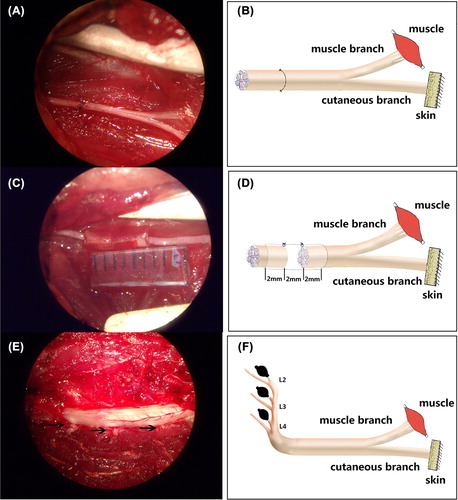 Figure 1. Operating microscope images (A, C, E, 5.5×) displaying the gross anatomy of the surgical procedures and the corresponding schematic drawings (B, D, F). A and B demonstrate the surgical procedures of repairing the femoral nerve by epineurium neurorrhaphy. C and D demonstrate the surgical procedures for repairing the femoral nerve by small gap sleeve bridging with a biodegradable chitin conduit. The 6 mm biodegradable chitin conduits were placed at the repair site and a 2 mm gap was maintained between the proximal and distal nerve segments. E and F demonstrate the removal of the sensory axons by ablating the right L2–4 DRGs and the arrows in photo E indicate the right L2–4 DRGs.