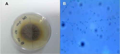 Figure 4 Mycological culture of sporotrichosis. (A) Colony morphology of isolated Sporothrix schenckii grown on potato dextrose agar at 25°C following incubation for 2 weeks. (B) The isolated strain was identified using microscopy with lactophenol cotton blue staining.