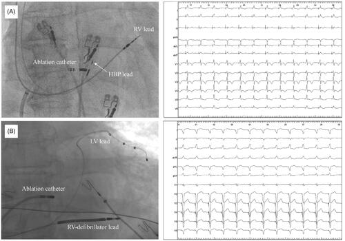 Figure 1. Fluoroscopic view of the ablation catheter in relation to His bundle pacing (Panel A) or biventricular pacing (Panel B) leads and 12-lead ECG after atrioventricular node ablation during both pacing modalities. RV: right ventricular; LV: left ventricular.