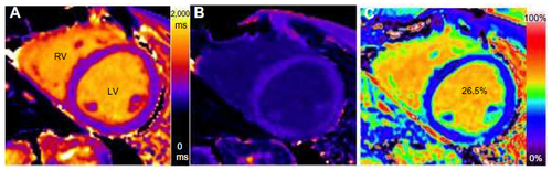 Figure 1 T1 mapping in a healthy volunteer.