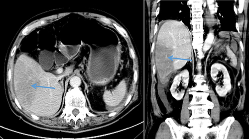 Figure 5 The lesion density on enhanced scan showed no obvious enhancement, and the density was significantly lower than that of normal liver parenchyma, with no obvious space-occupying effect. Small blood vessels could be seen in the lesion, and no capsule could be seen (Left figure). Coronal view showing wedge-shaped lesions in the liver (fan-shaped changes) (Right figure). The left blue arrow indicates the liver infarction lesion seen on the axial enhanced CT, while the right blue arrow indicates the liver infarction lesion seen on the coronal view.