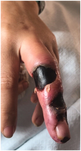 Figure 6. Skin with deep necrosis ulcers (10th day post-trauma).