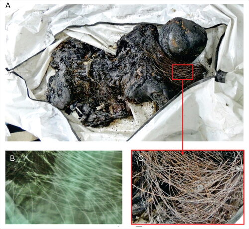 Figure 1. Posterior view of the human carbonized remains surrounded by multiple metallic filaments that involve the cervical and thoracoabdominal regions (A). High-density filaments in the radiological examination (B) and a close view of the filaments after opening the body bag (C).