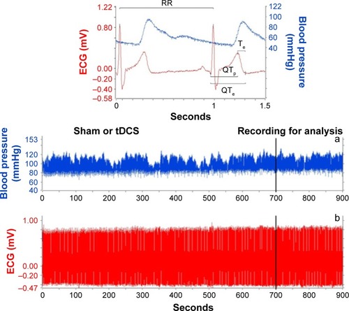 Figure 2 An example of a 15-minute recording during sham or real anodal transcranial direct current stimulation (tDCS).