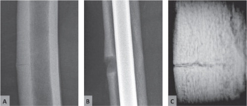 Figure 7. Incomplete fracture. A: conventional radiograph. B: Cortical defect after taking a biopsy. C: Microradiography of the bone biopsy. Note the fracture line.