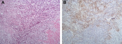 Figure 3 Anti-PD-L1 immunohistochemistry of bladder cancer tissues.