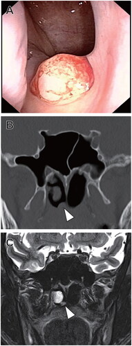 Figure 1. (A) Endoscopic examination of the right nasal cavity showed a mass on the nasal floor. (B, C) Coronal computed tomography and coronal Short TI inversion recovery magnetic resonance imaging showed an approximately 5-mm mass on the nasal floor (arrowhead).