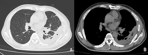 Figure 2 Follow-up chest CT after thoracic drainage and 1 week of meropenem anti-infective treatment. (A) Lung windows (B) Mediastinal windows.