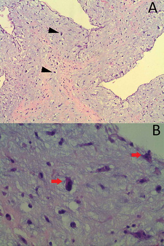 Figure 4. H&E staining at 100× (A) and 400× (B) revealed ovoid to spindled and satellite cells arranged in cords, microtrabeculae, and nests within a prominent myxoid matrix (arrow), and haemosiderin deposition (arrowheads) that was consistent with the diagnosis of myxoma