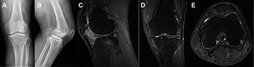 Figure 4 After five years, X-rays and MRI scans of the left knee joint were taken. (A and B) The X-rays showed that the distal femur and proximal tibia had resolved from the previous abnormal X-ray appearances. (C–E) It was also noted that the MRI changes were largely resolved.