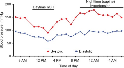Figure 5 24-Hour blood pressure variability in a patient with autonomic failure leading to daytime nOH and nighttime supine hypertension.