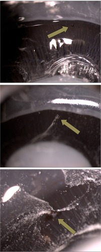 Figure 2 Sclerotomy slit-lamp photographs. The top photo was identified as absence of vitreous entrapment (grade 0), the center photo was classified as presence of delicate vitreous strands directed to the inner hole of the incision (grade 1), and the bottom photo was classified as existence of thick vitreous strands aimed toward the sclerotomy (grade 2).