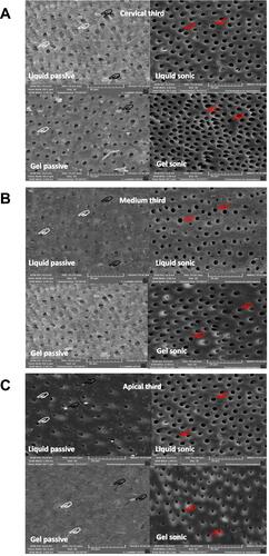 Figure 3 Representative SEM images of each third ((A) cervical; (B) medium; (C) apical) of the conditioning pattern observed in the experimental groups. It was observed that, in all thirds, the liquid and gel applied as passive technique shows dentinal surfaces with smear layer debris (black hands) and partially opened tubules due to the presence of smear plugs (white hands). On the other side, in the groups where the liquid and gel etchants were applied in the sonic mode, it was a more complete opening of the dentinal tubules (red hands).