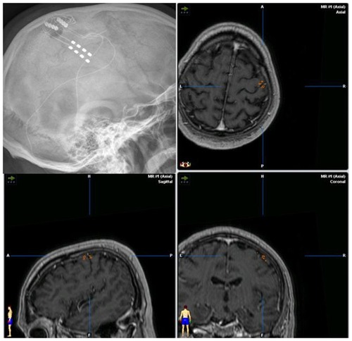 Figure 1 Lateral x-ray of the skull documenting the position of the implanted paddle leads. Matching of postoperative ct-scan and preoperative MRI-3D-neuronavigation data with inserted position of the leads over the pre- and postcentral gyrus.