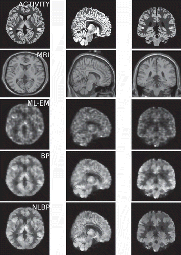 Figure 3. Brain simulation illustrating (top to bottom) raw emission data; co-registered MR; conventional MLEM reconstruction; reconstructions using a conventional Bowsher prior (BP) and a modified prior with non-local weighting (NLBP) (image courtesy Daniil Kazantsev, UCL).