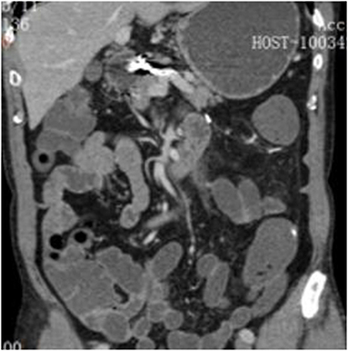 Figure 7 Reexamination based on an abdominal computed tomography scan showed postoperative changes in the proximal branch aneurysms of the common hepatic artery.