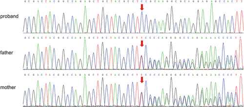 Figure 1 Sanger sequencing of the girl and the parents. Up panel: the girl with CCNO gene (NM-021147.5) at c.323del. Middle and down panel: the father and the mother with heterozygous mutation in CCNO gene.