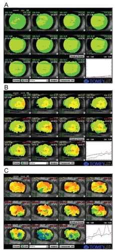 Figure 5 Representative TSAS data of patients with mild (A), moderate (B) and severe damage of tear film stability (C). Graph shows the consecutive changes in SRI (surface regularity index, blue line) and SAI (surface asymmetry index, red line).