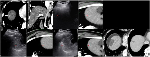 Figure 3. Percutaneous ablation for a subdiaphragmatic hepatocellular carcinoma (HCC) with artificial ascites under fusion image guidance. Contrast-enhanced axial (A) and coronal (B) arterial phase CT images displays a 1.2-cm hypervascular HCC (arrows) abutting the diaphragm in segment VIII of the liver. (C) Fusion imaging technique between real-time working US and reference arterial phase CT images cannot display the target lesion (red cross) due to the lung shadow. (D) After artificial ascites (arrowheads) injection between the diaphragm and liver dome, the target lesion is clearly visualized as a low echoic nodule (red cross) under fusion imaging guidance. (E) After radiofrequency energy delivery, the echo-cloud of micro-bubbles is created around the target lesion. (F) Immediate follow-up contrast-enhanced portal venous phase axial CT demonstrates complete destruction of the target lesion with sufficient ablation margin. (G) There was no local tumor progression at the 32-month follow-up CT.