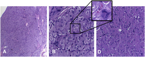 Figure 4 (A) The tumor mass was lobulated had indistinct border; (B) spherical nuclei of tumor cells, pleomorphic, granulated eosinophilic cytoplasm, (high power field, 400x); (C) Reinke crystal. (D) Solid tumors formed nest.