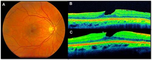 Figure 3 This 62-year-old woman demonstrates a lamellar macular hole. The baseline best-corrected visual acuity (BCVA) was 20/40 and the final BCVA was also 20/40. (A) Fundus photograph; (B) baseline OCT image; (C) OCT image after 24 months follow-up.