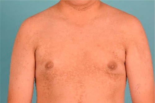 Figure 2 Reticulate hyperpigmentation with fine scaling over anterior chest, shoulders, and upper arms.