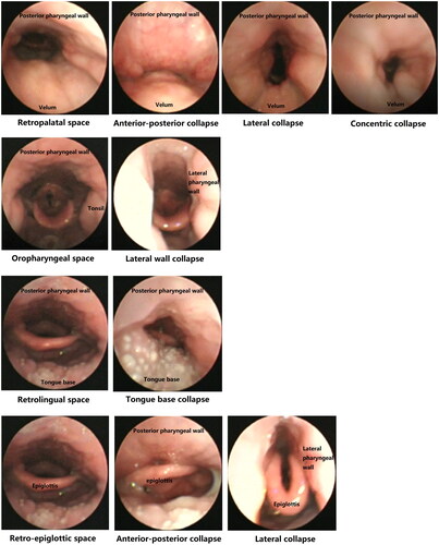 Figure 1. Collapse configurations of different obstructive sites. Airway configurations in velum, lateral oropharyngeal wall, tongue base and epiglottis during normal breathing and inspiratory apnoea were shown in the figure. The leftmost pane showed the normal airway as normal breathing. Inspiratory airway collapse occurred during obstructive apnoea, various configurations were showed on the right, that included anterior-posterior, anterior structures moving posteriorly against the posterior pharyngeal wall; lateral, lateral pharyngeal structures moving towards to the midline of the lumen; concentric, a combination of anterior–posterior plus lateral wall movement. The images were taken from the DISE videos of the authors’ unit to illustrate the different collapse patterns. The DISE was operated by author C.Z, and images were provided by the author C.Z. No patient privacy or informed consent was involved, and no permissions were required for accessing these images.