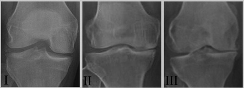 Figure 1. Representative radiographs of patients with different OA grades. Radiographs II (n = 22) and III (n = 15) demonstrated the degenerative changes of OA while radiographs I (n = 9) illustrated a preserved joint space.