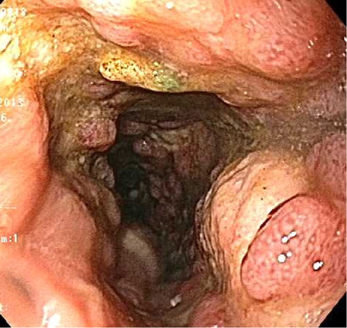 Fig. 3 Sigmoidoscopic examination demonstrating friable deeply ulcerated mucosa in sigmoid and descending colon.