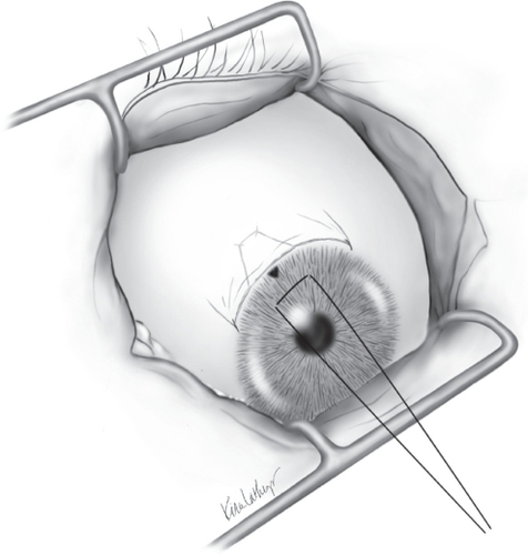 Figure 2 Two interrupted 9-0 vicryl sutures reapproximate the conjunctiva at the end of the case.