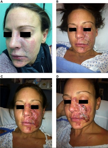 Figure 15 Progression of vascular compromise after an embolic event.